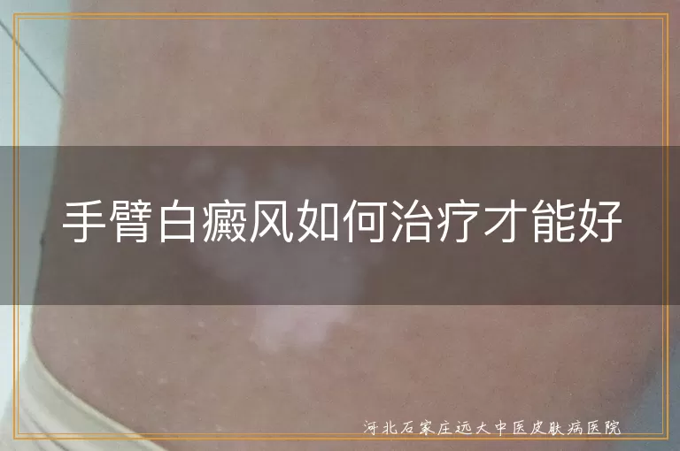 手臂白癜风如何治疗才能好