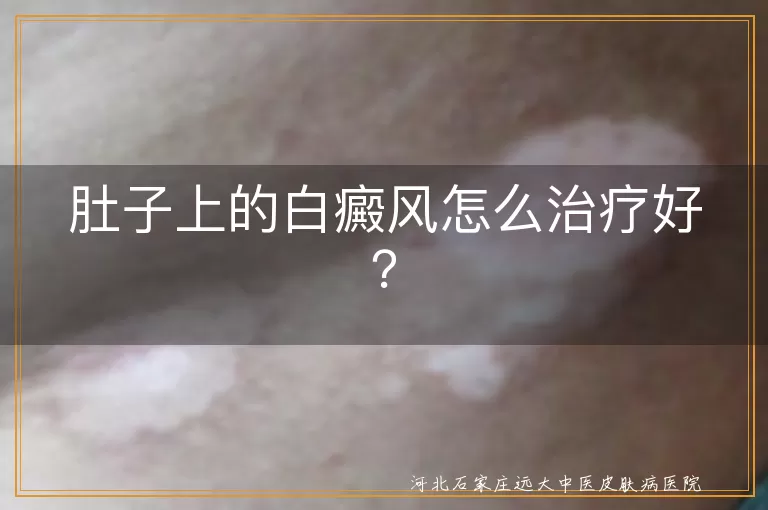 肚子上的白癜风怎么治疗好？