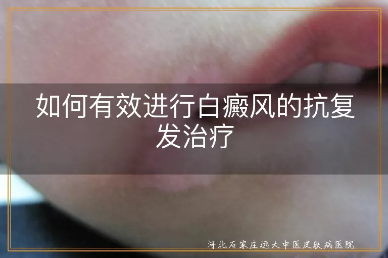 如何有效进行白癜风的抗复发治疗