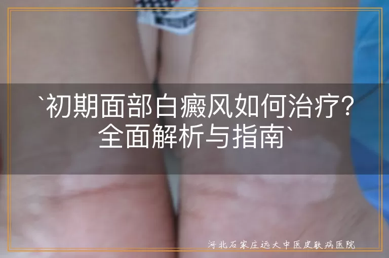 初期面部白癜风如何治疗？全面解析与指南