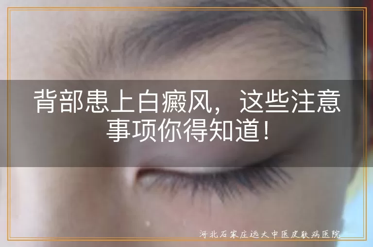 背部患上白癜风，这些注意事项你得知道！