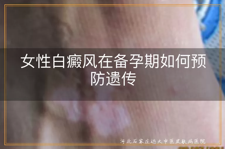 女性白癜风在备孕期如何预防遗传