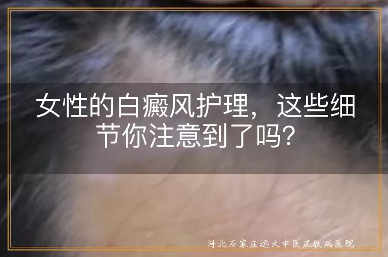 女性,白癜风,护理,防晒,清洁,保湿,饮食调理,心理调适,复诊,科学治疗