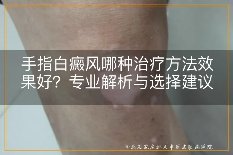 手指白癜风,治疗方法,药物治疗,光疗,手术治疗,移植治疗,注意事项