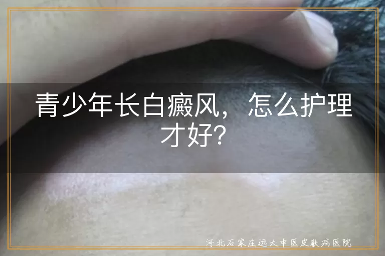 青少年长白癜风，怎么护理才好？