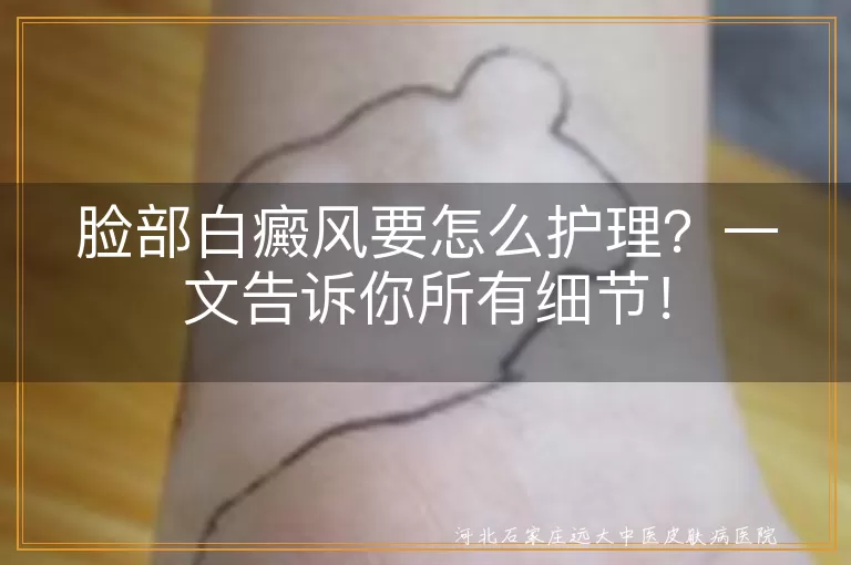 脸部白癜风要怎么护理？一文告诉你所有细节！