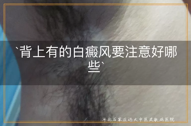 背上有的白癜风要注意好哪些