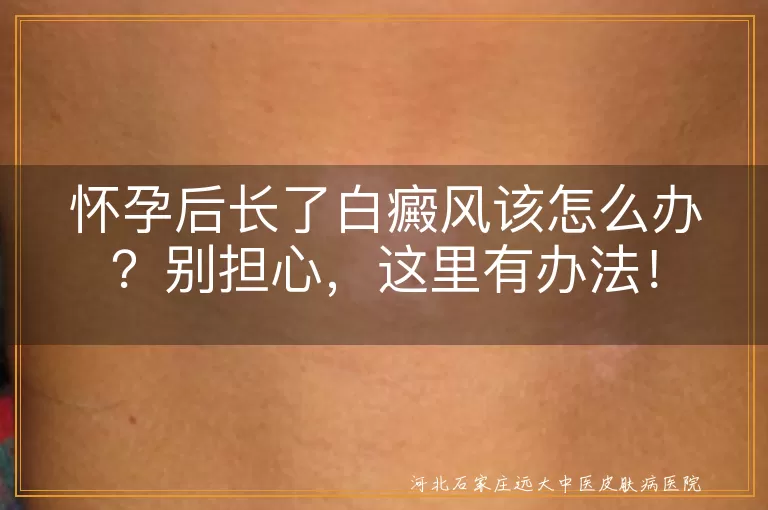 怀孕,白癜风,治疗,日常护理,饮食调整,心情调节,家人支持