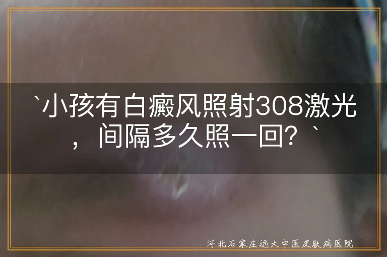 白癜风,308激光照射,小孩,间隔时间,病情,体质,年龄,治疗