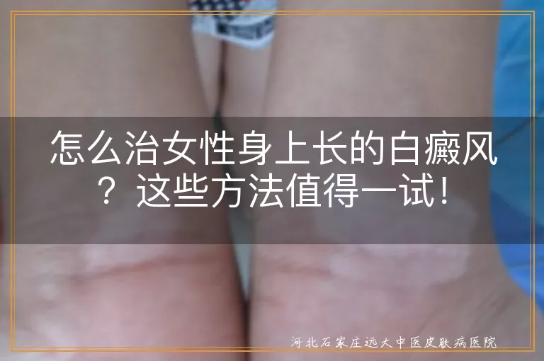 白癜风,女性,治疗方法,药物治疗,光疗,激光治疗,手术治疗,生活调理,持久战,耐心