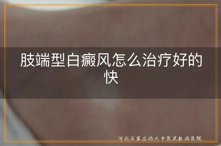 肢端型白癜风,综合治疗,药物治疗,光疗,手术治疗,中医治疗,日常护理,坚持治疗
