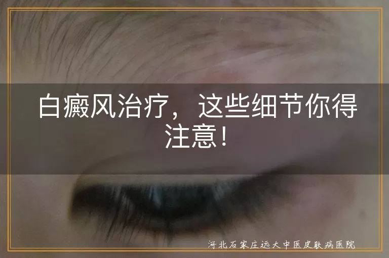 白癜风治疗，这些细节你得注意！