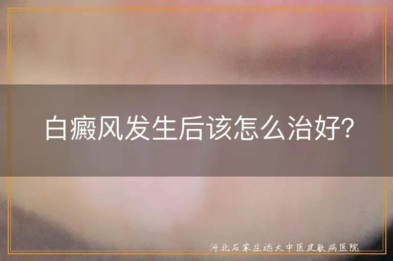 白癜风发生后该怎么治好？