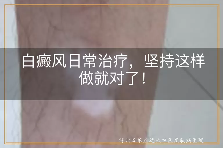 白癜风日常治疗，坚持这样做就对了！