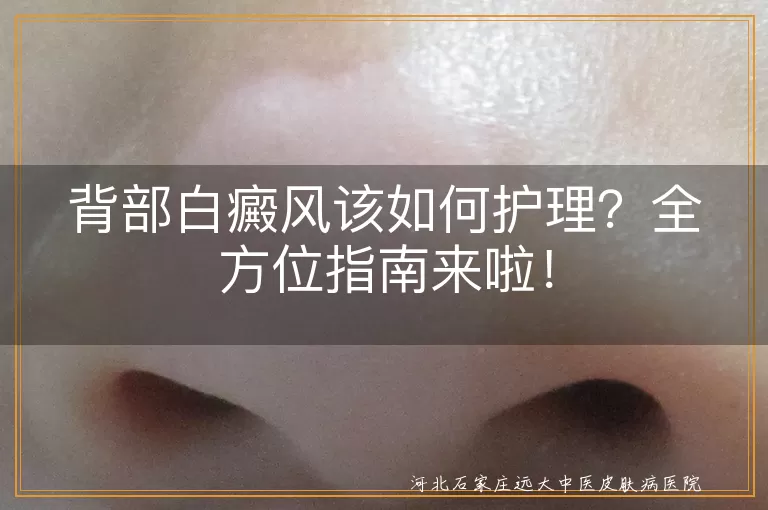 背部白癜风,护理,清洁,保湿,防晒,光疗,药物治疗,激光治疗,生活习惯,心态调整