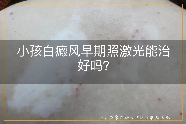小孩白癜风早期照激光能治好吗？