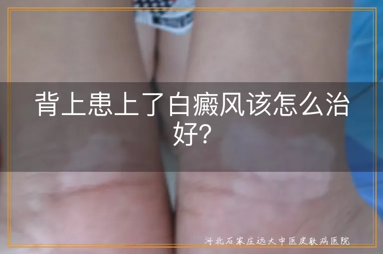 背上患上了白癜风该怎么治好？