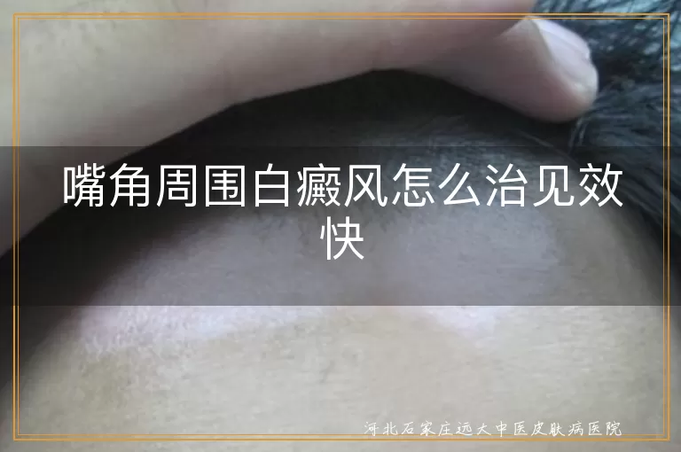 嘴角周围白癜风怎么治见效快