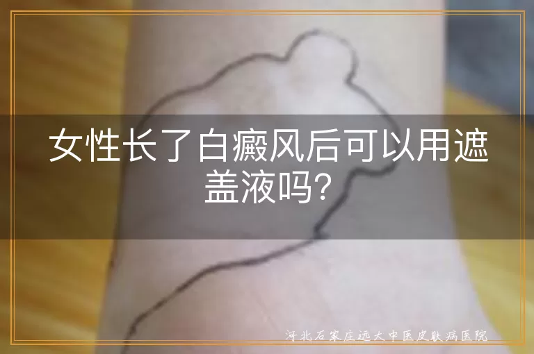 女性长了白癜风后可以用遮盖液吗？