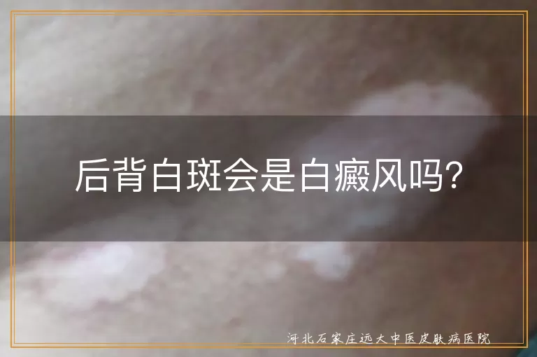 后背白斑会是白癜风吗？