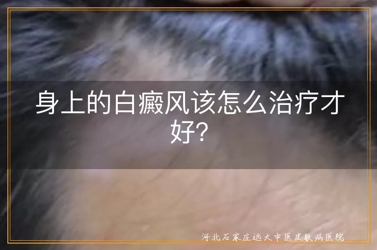 身上的白癜风该怎么治疗才好？