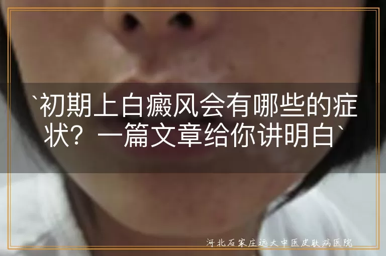 初期上白癜风会有哪些的症状？一篇文章给你讲明白