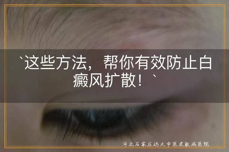 白癜风,扩散,生活习惯,皮肤保护,治疗,复诊,心理调适