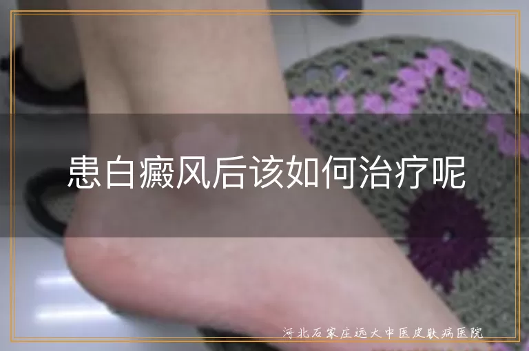 患白癜风后该如何治疗呢