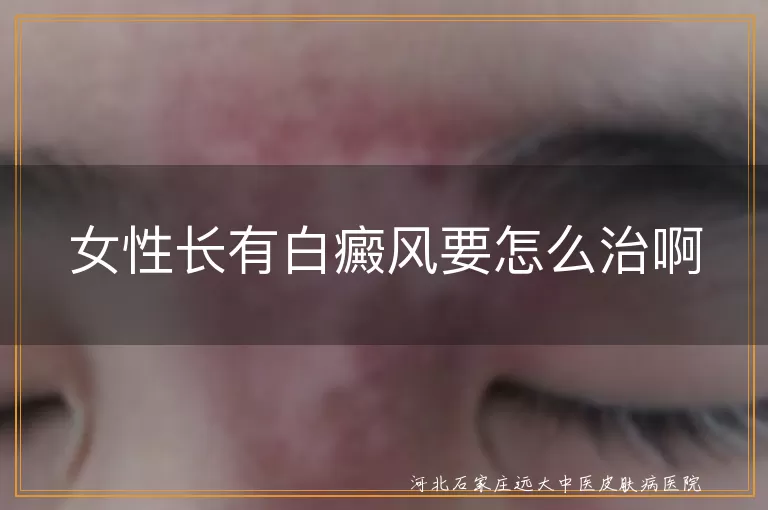 女性长有白癜风要怎么治啊