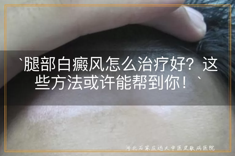 腿部白癜风怎么治疗好？这些方法或许能帮到你！