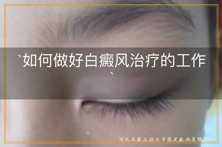 如何做好白癜风治疗的工作