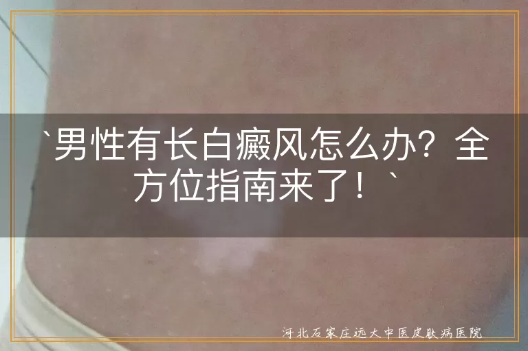 男性有长白癜风怎么办？全方位指南来了！
