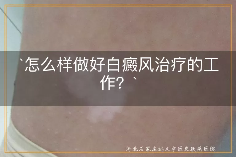 怎么样做好白癜风治疗的工作？