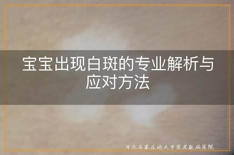 宝宝白斑,白癜风,花斑癣,单纯糠疹,治疗方法,就医检查,日常护理,心理关怀