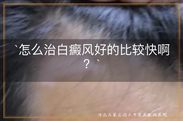 `白癜风`,`治疗`,`药物`,`光疗`,`激光治疗`,`手术治疗`,`预防`,`耐心`,`保护皮肤`,`调整心态`