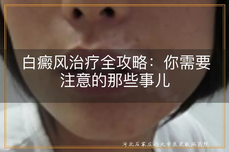 白癜风治疗全攻略：你需要注意的那些事儿