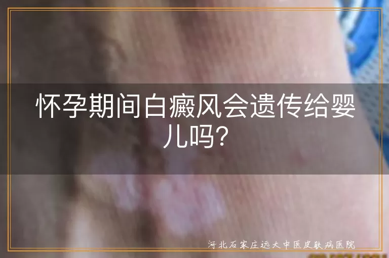怀孕期间白癜风会遗传给婴儿吗？