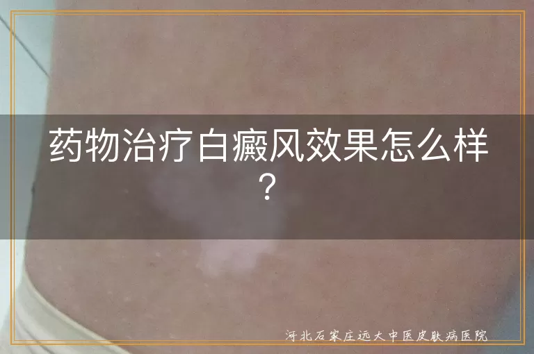 药物治疗白癜风效果怎么样？