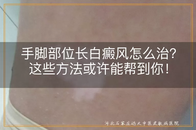 手脚部位长白癜风怎么治？这些方法或许能帮到你！