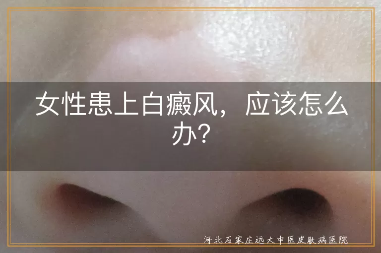女性患上白癜风，应该怎么办？