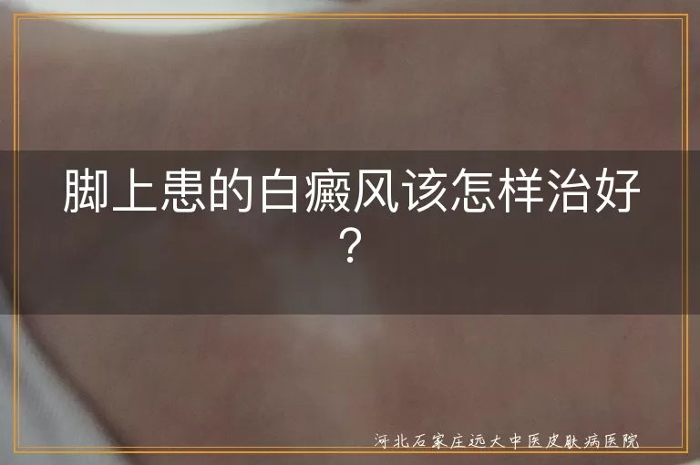 脚上白癜风,治疗方法,药物治疗,光疗,手术治疗,生活调理,注意事项