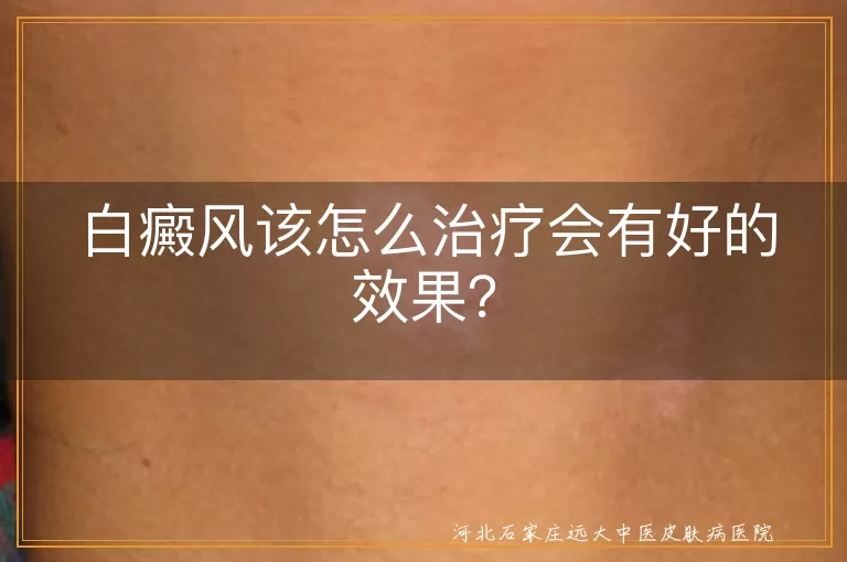 白癜风该怎么治疗会有好的效果？