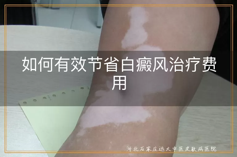 如何有效节省白癜风治疗费用