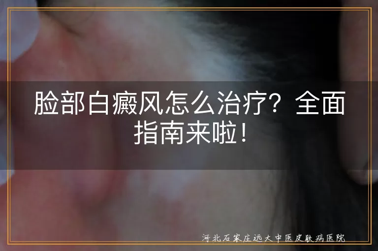 脸部白癜风,治疗方法,药物治疗,光疗,手术治疗,中医治疗,注意事项