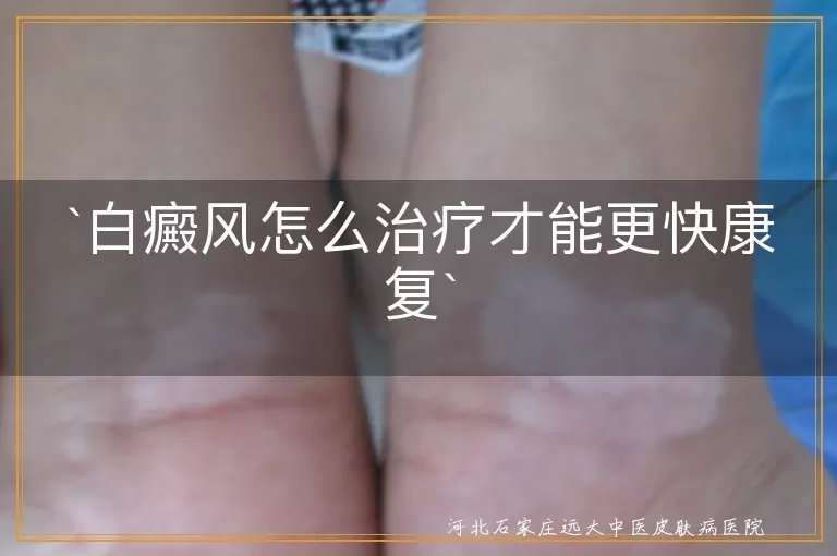 白癜风怎么治疗才能更快康复