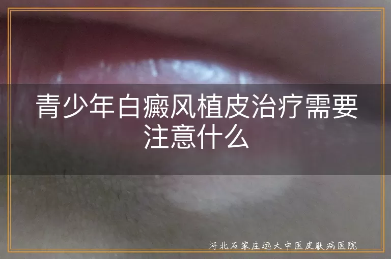 青少年白癜风植皮治疗需要注意什么