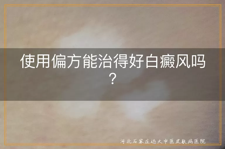 使用偏方能治得好白癜风吗？