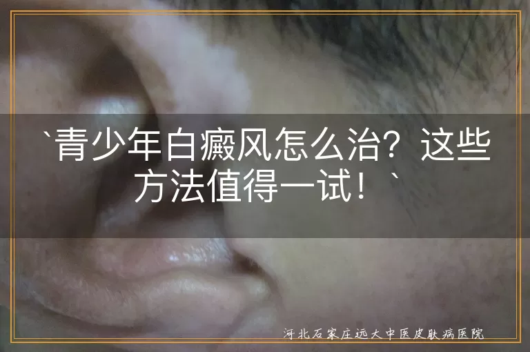 青少年白癜风怎么治？这些方法值得一试！