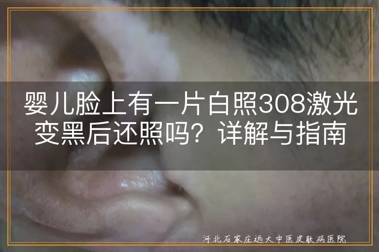 婴儿脸上有一片白照308激光变黑后还照吗？详解与指南