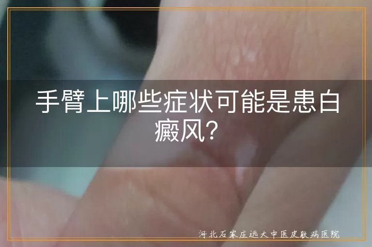 手臂上哪些症状可能是患白癜风？